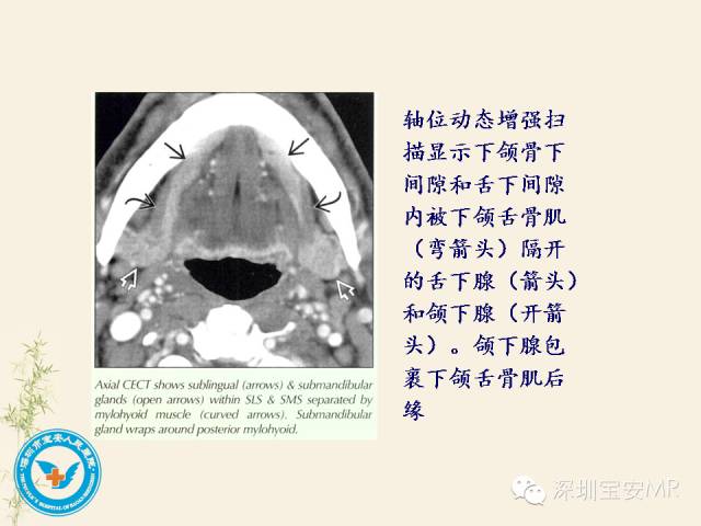 【PPT】舌和口底影像解剖及临床病例一组