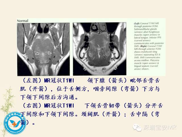 【PPT】舌和口底影像解剖及临床病例一组