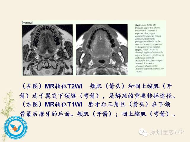 【PPT】舌和口底影像解剖及临床病例一组