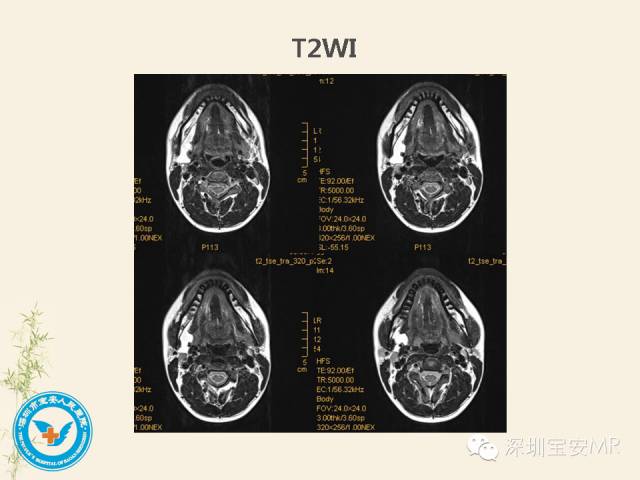 【PPT】舌和口底影像解剖及临床病例一组