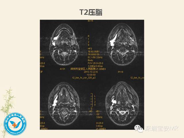 【PPT】舌和口底影像解剖及临床病例一组