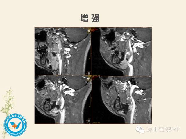 【PPT】舌和口底影像解剖及临床病例一组
