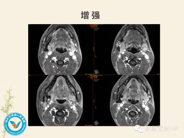 【PPT】舌和口底影像解剖及临床病例一组