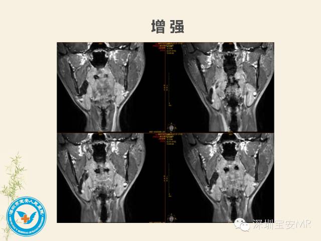 【PPT】舌和口底影像解剖及临床病例一组