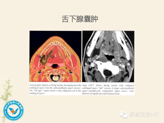 【PPT】舌和口底影像解剖及临床病例一组