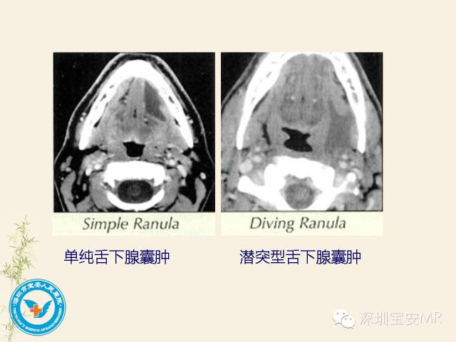 【PPT】舌和口底影像解剖及临床病例一组