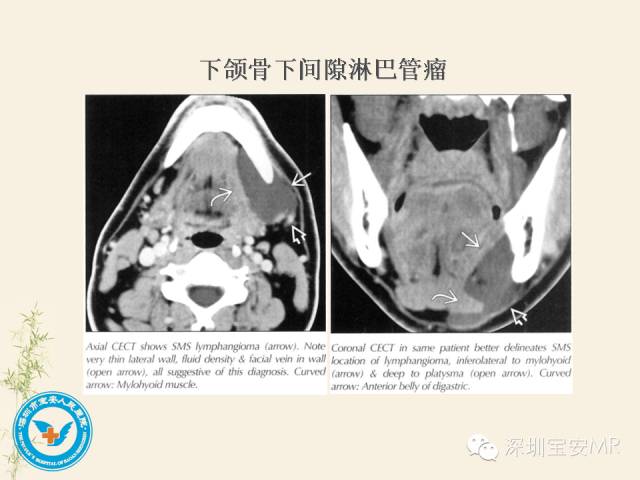 【PPT】舌和口底影像解剖及临床病例一组