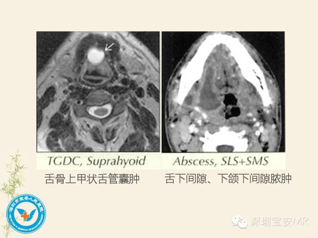 【PPT】舌和口底影像解剖及临床病例一组