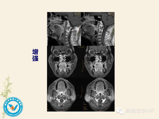 【PPT】舌和口底影像解剖及临床病例一组