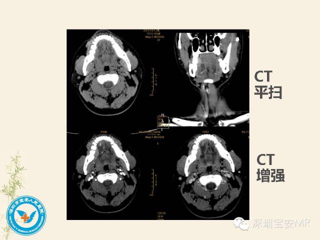 【PPT】舌和口底影像解剖及临床病例一组