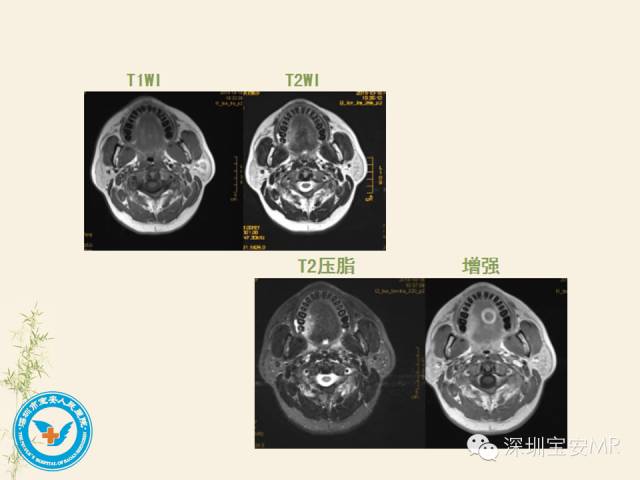 【PPT】舌和口底影像解剖及临床病例一组