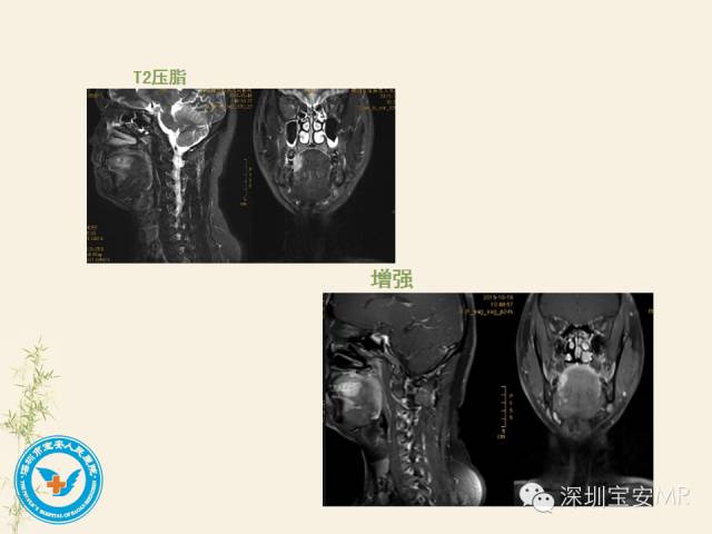 【PPT】舌和口底影像解剖及临床病例一组