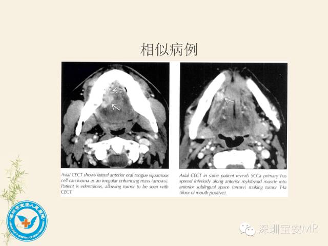 【PPT】舌和口底影像解剖及临床病例一组