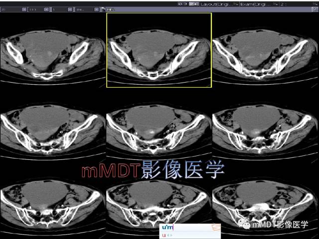【PPT】卵巢Brenner瘤影像诊断