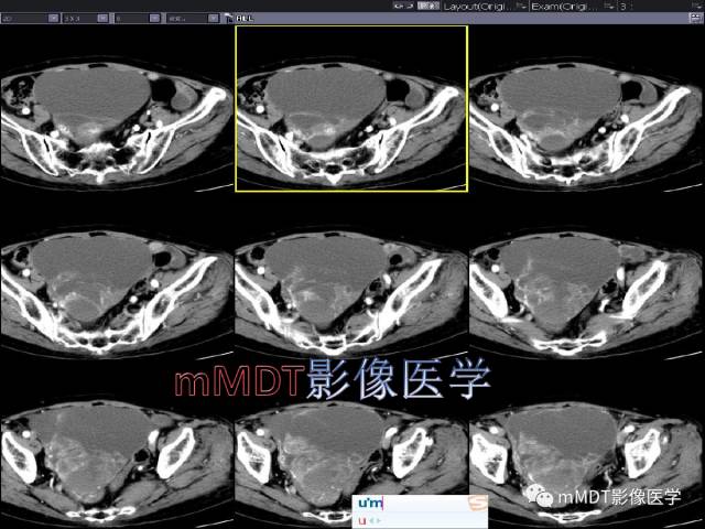 【PPT】卵巢Brenner瘤影像诊断