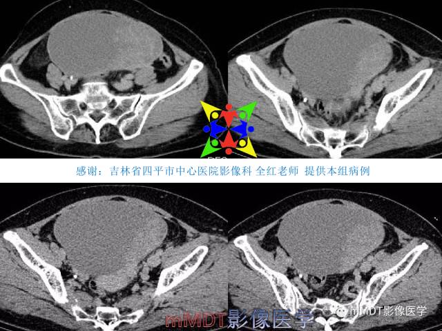 【PPT】卵巢Brenner瘤影像诊断