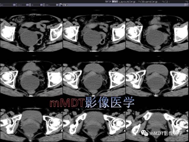 【PPT】卵巢Brenner瘤影像诊断