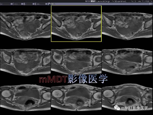【PPT】卵巢Brenner瘤影像诊断