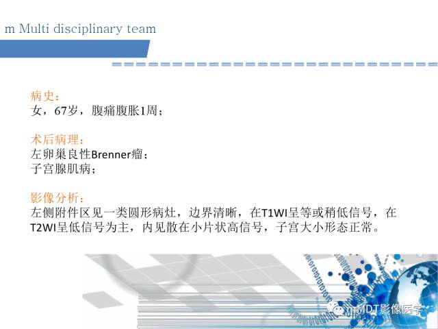 【PPT】卵巢Brenner瘤影像诊断