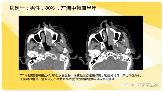 【PPT】鼻腔鼻窦黑色素瘤影像诊断与鉴别