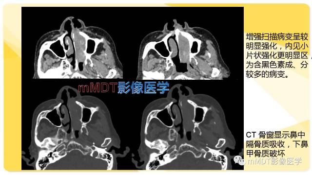 【PPT】鼻腔鼻窦黑色素瘤影像诊断与鉴别