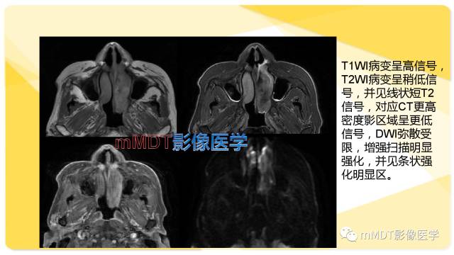 【PPT】鼻腔鼻窦黑色素瘤影像诊断与鉴别