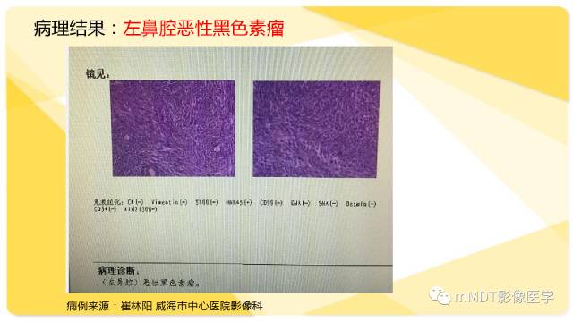【PPT】鼻腔鼻窦黑色素瘤影像诊断与鉴别
