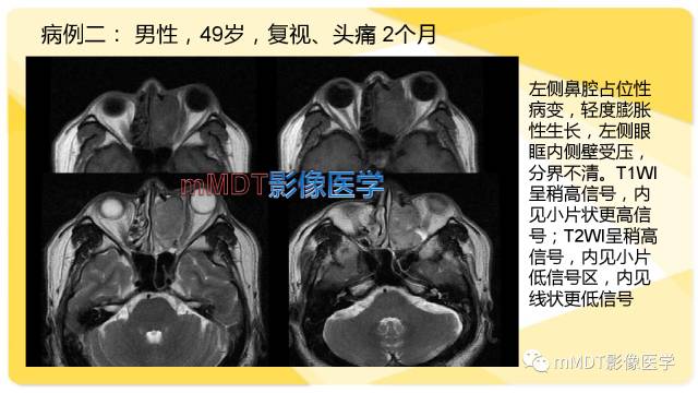 【PPT】鼻腔鼻窦黑色素瘤影像诊断与鉴别
