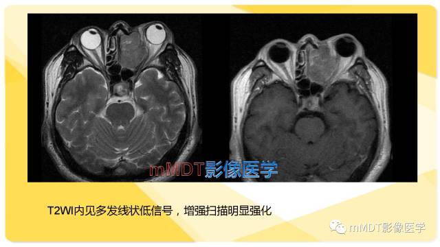 【PPT】鼻腔鼻窦黑色素瘤影像诊断与鉴别