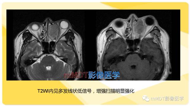 【PPT】鼻腔鼻窦黑色素瘤影像诊断与鉴别