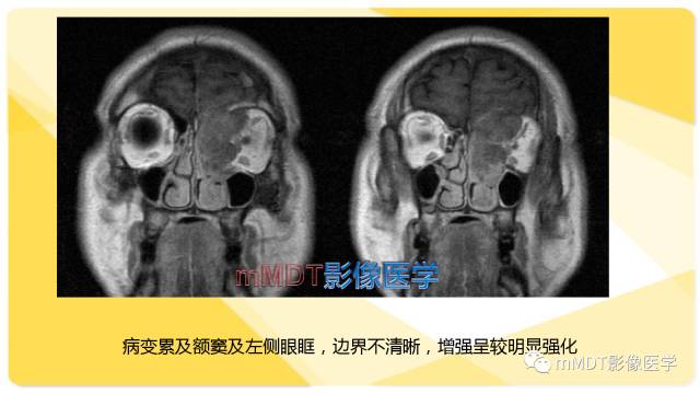 【PPT】鼻腔鼻窦黑色素瘤影像诊断与鉴别