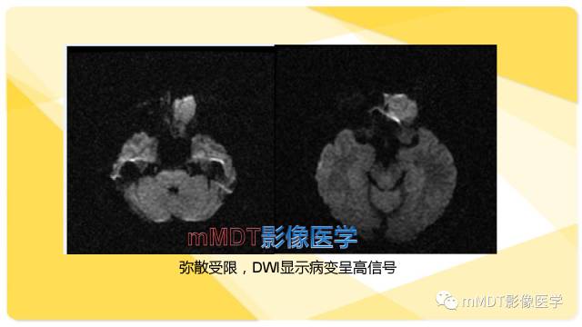 【PPT】鼻腔鼻窦黑色素瘤影像诊断与鉴别