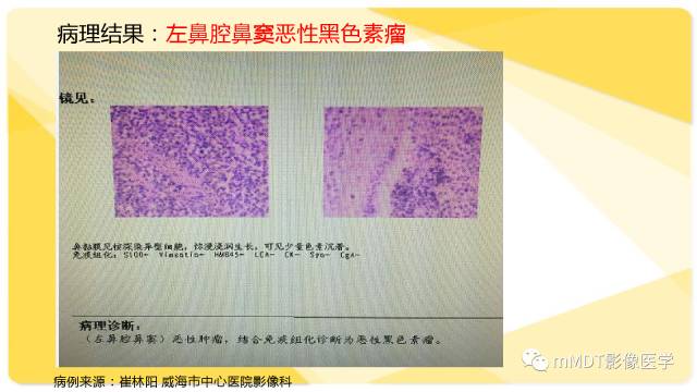 【PPT】鼻腔鼻窦黑色素瘤影像诊断与鉴别
