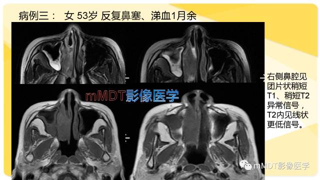 【PPT】鼻腔鼻窦黑色素瘤影像诊断与鉴别