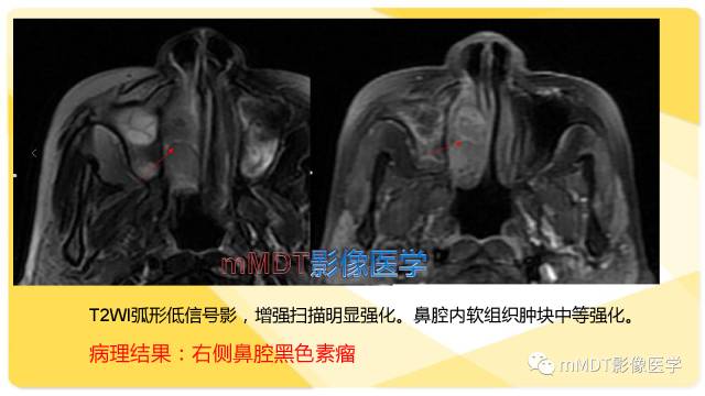 【PPT】鼻腔鼻窦黑色素瘤影像诊断与鉴别