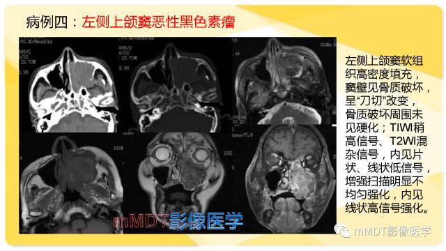 【PPT】鼻腔鼻窦黑色素瘤影像诊断与鉴别