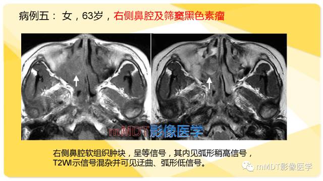 【PPT】鼻腔鼻窦黑色素瘤影像诊断与鉴别