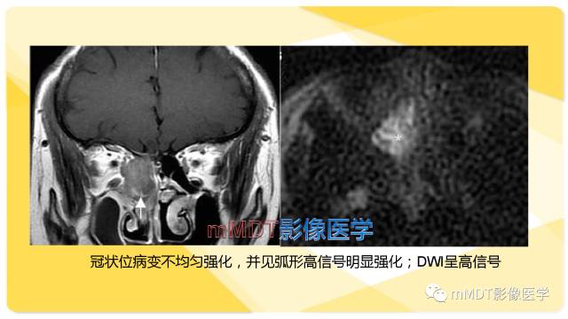 【PPT】鼻腔鼻窦黑色素瘤影像诊断与鉴别