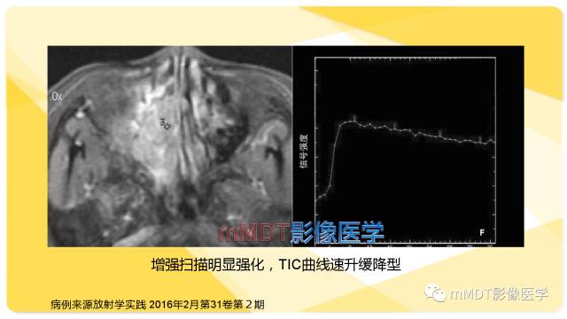 【PPT】鼻腔鼻窦黑色素瘤影像诊断与鉴别