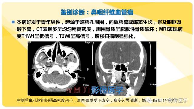【PPT】鼻腔鼻窦黑色素瘤影像诊断与鉴别