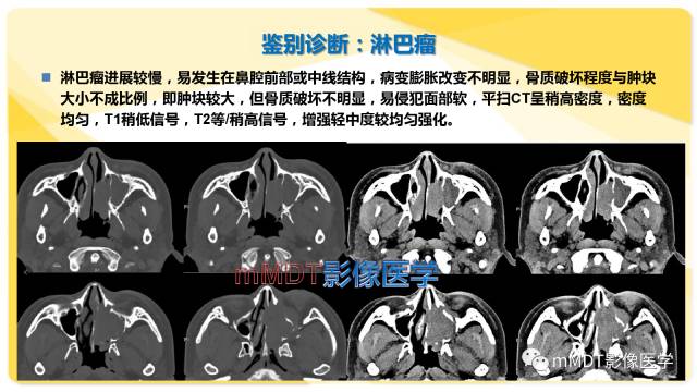 【PPT】鼻腔鼻窦黑色素瘤影像诊断与鉴别