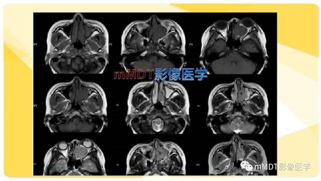 【PPT】鼻腔鼻窦黑色素瘤影像诊断与鉴别