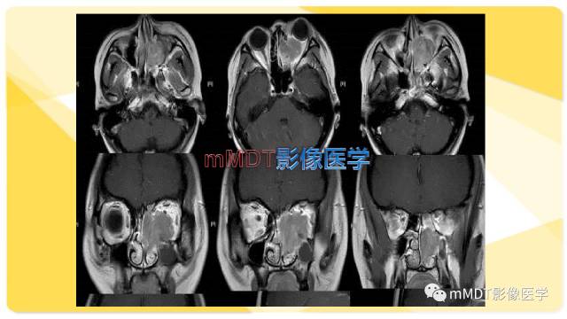 【PPT】鼻腔鼻窦黑色素瘤影像诊断与鉴别