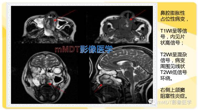 【PPT】鼻腔鼻窦黑色素瘤影像诊断与鉴别