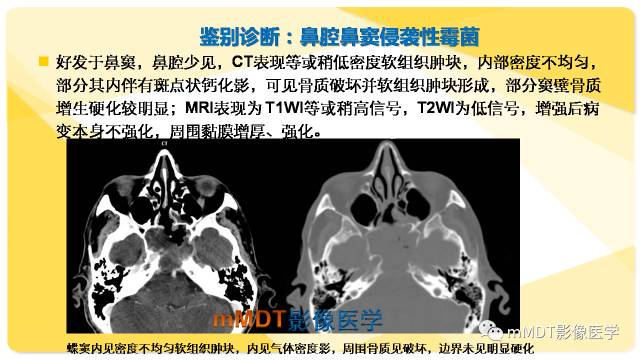 【PPT】鼻腔鼻窦黑色素瘤影像诊断与鉴别