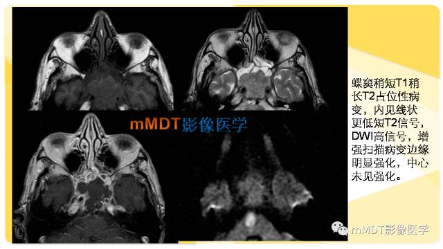 【PPT】鼻腔鼻窦黑色素瘤影像诊断与鉴别