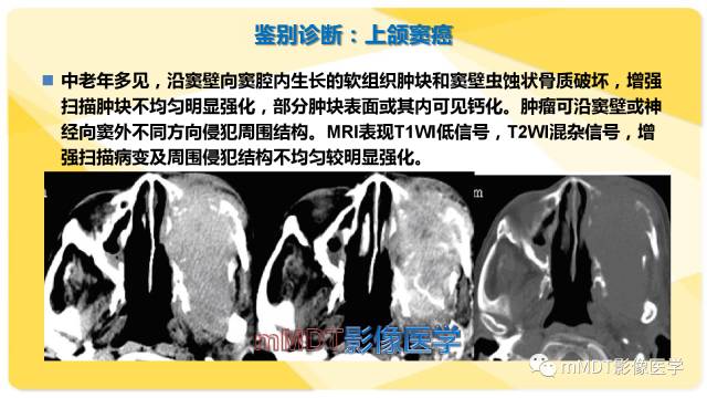 【PPT】鼻腔鼻窦黑色素瘤影像诊断与鉴别
