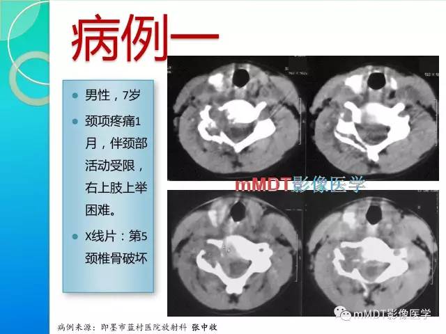 【PPT】不典型LCH诊断与鉴别诊断