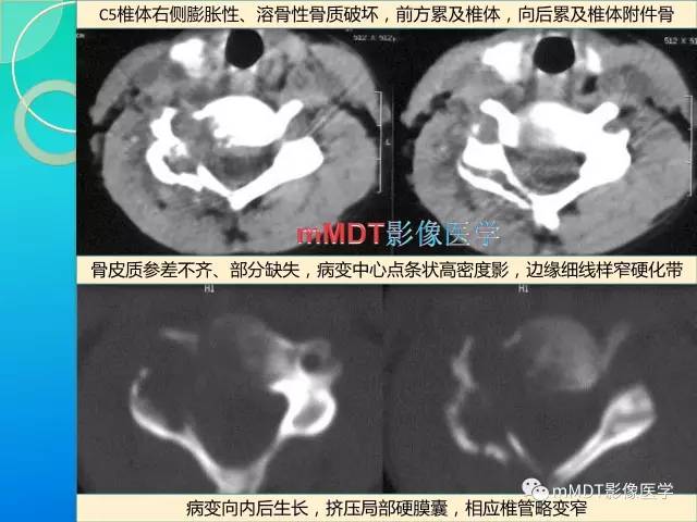 【PPT】不典型LCH诊断与鉴别诊断