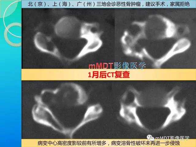 【PPT】不典型LCH诊断与鉴别诊断